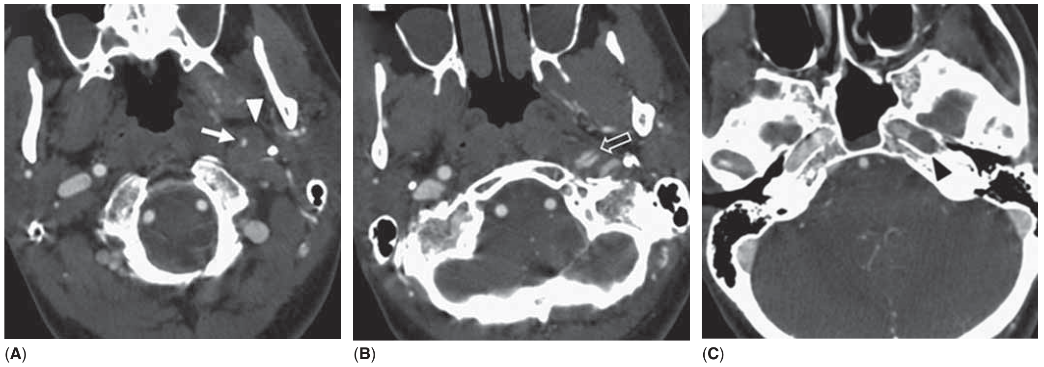 CTA bóc tách carotid cổ