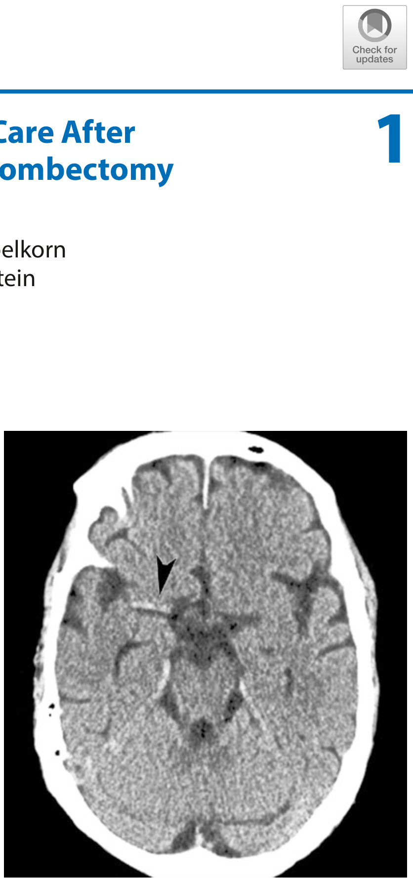 CT nền với dấu động mạch não giữa tăng đậm