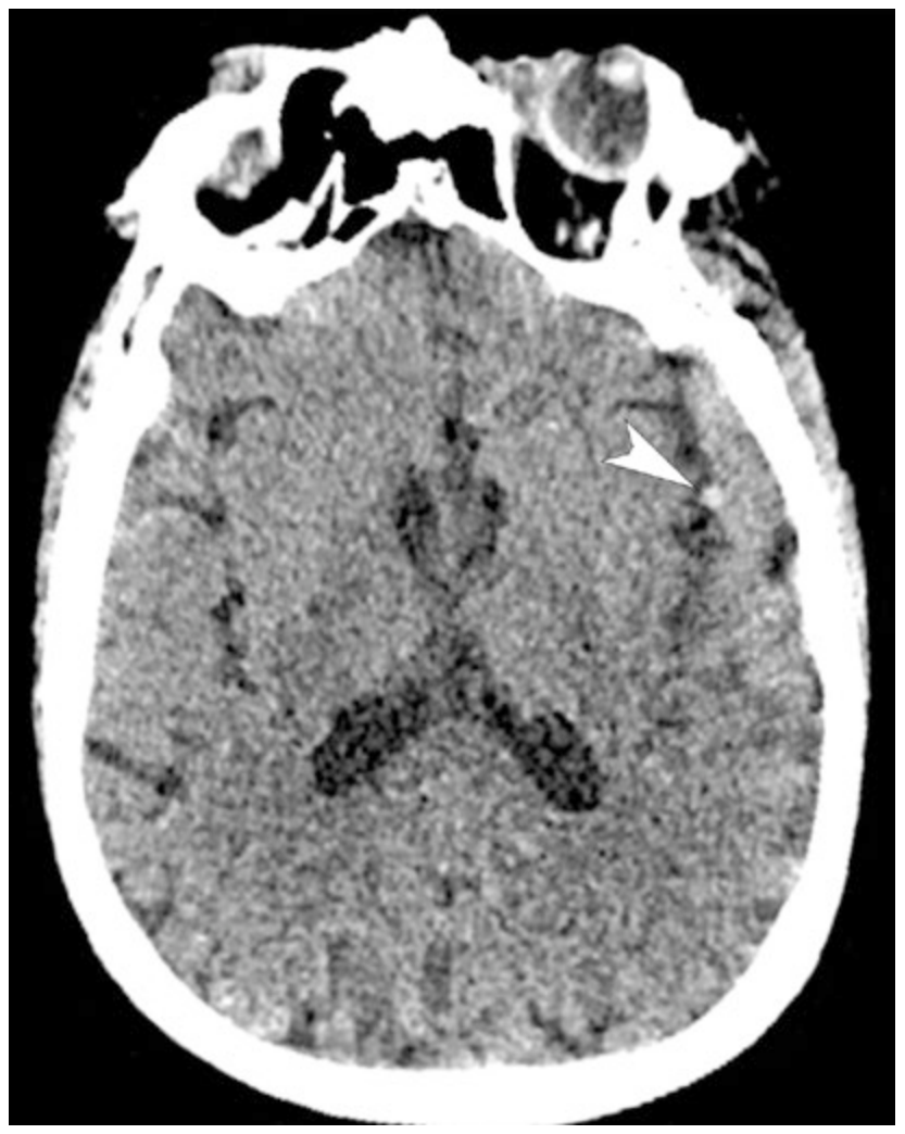 CT nhồi máu lớn trước nguy cơ chuyển dạng