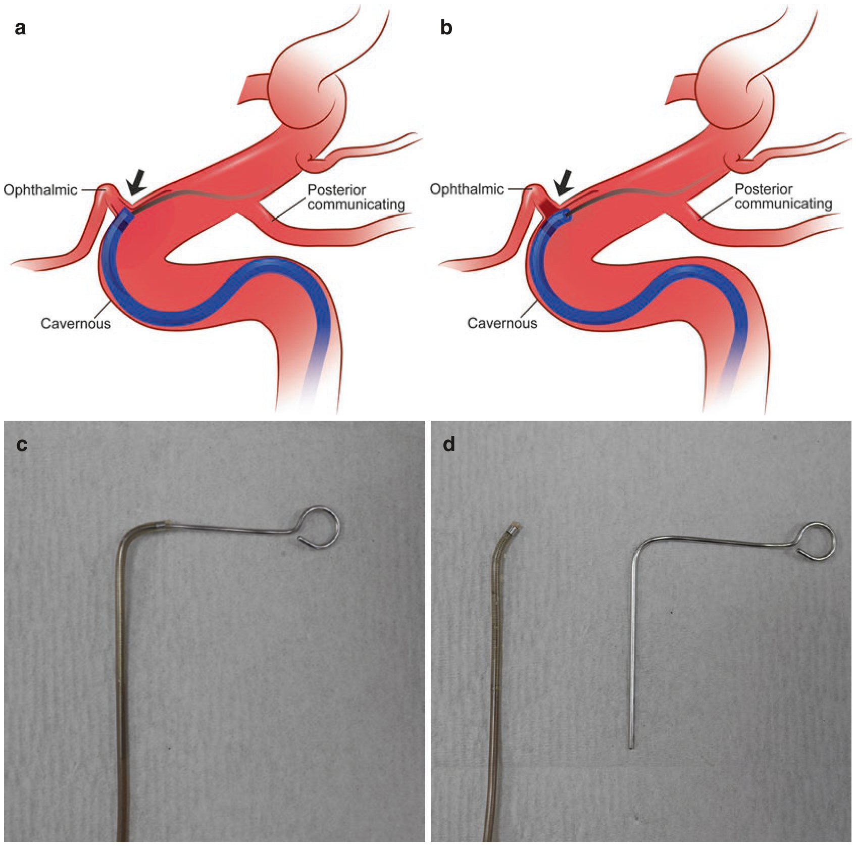 Khó đưa catheter qua siphon và gốc động mạch mắt