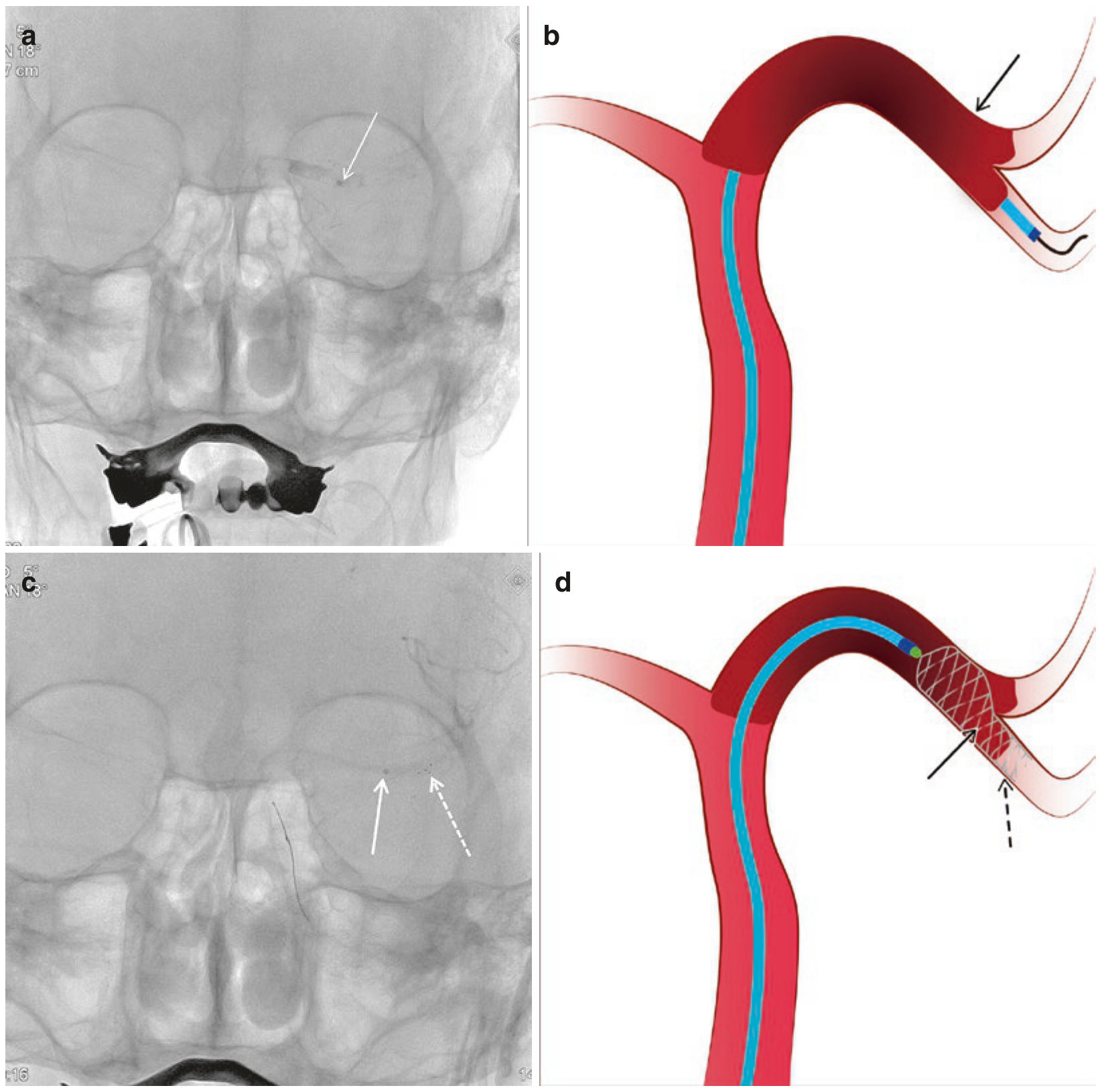 Chuỗi ảnh tiếp cận và bắt đầu triển khai stent retriever