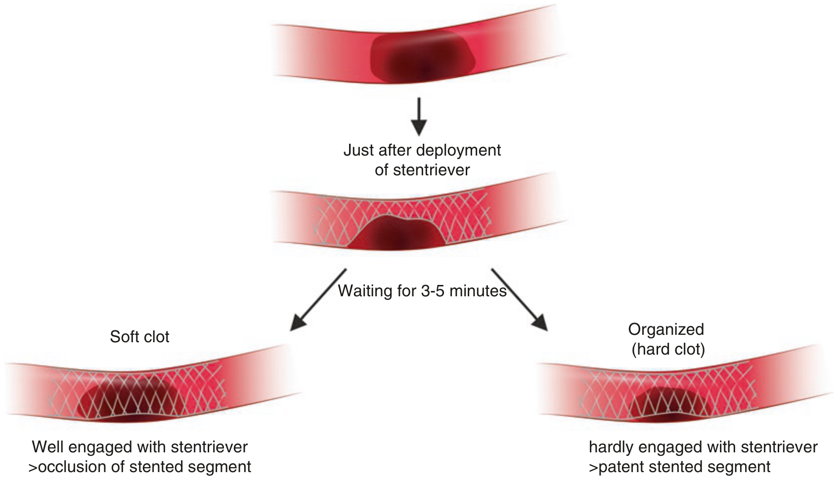 Mô hình tương tác giữa stent retriever và huyết khối