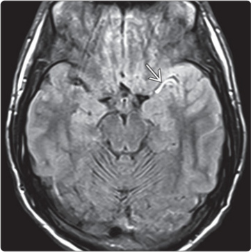 FLAIR vascular hyperintensity trong tắc MCA