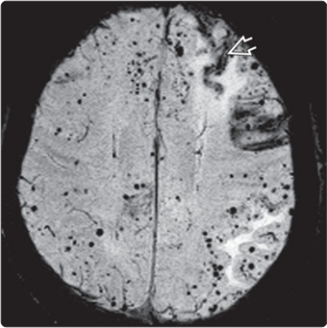 Phân bố vi xuất huyết và siderosis vỏ trong bệnh mạch amyloid