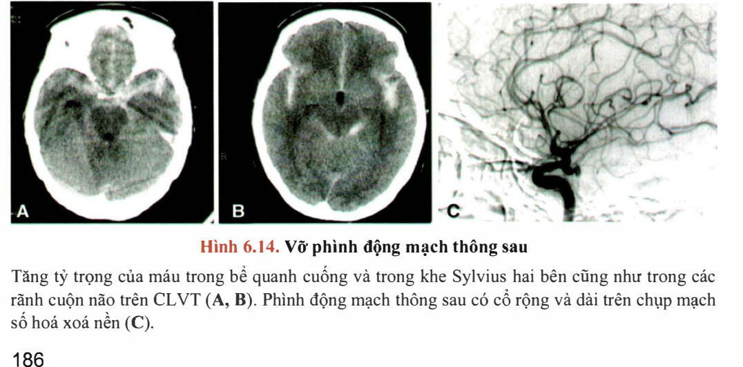SAH và phình PCom cổ rộng