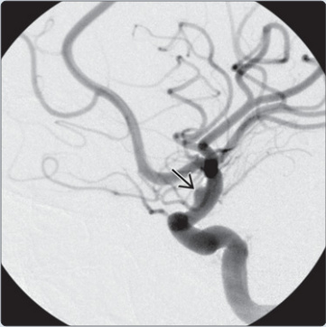 Blood blister-like aneurysm trên DSA