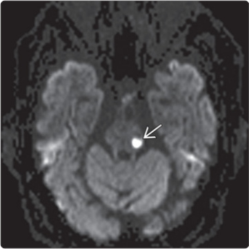 DWI minh họa nhồi máu vùng nhánh xuyên cầu não