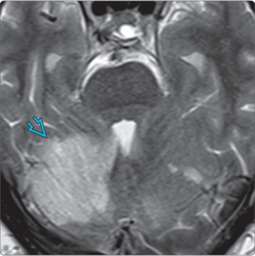 MRI T2 nhồi máu tiểu não phải thuộc vùng SCA có hiệu ứng khối