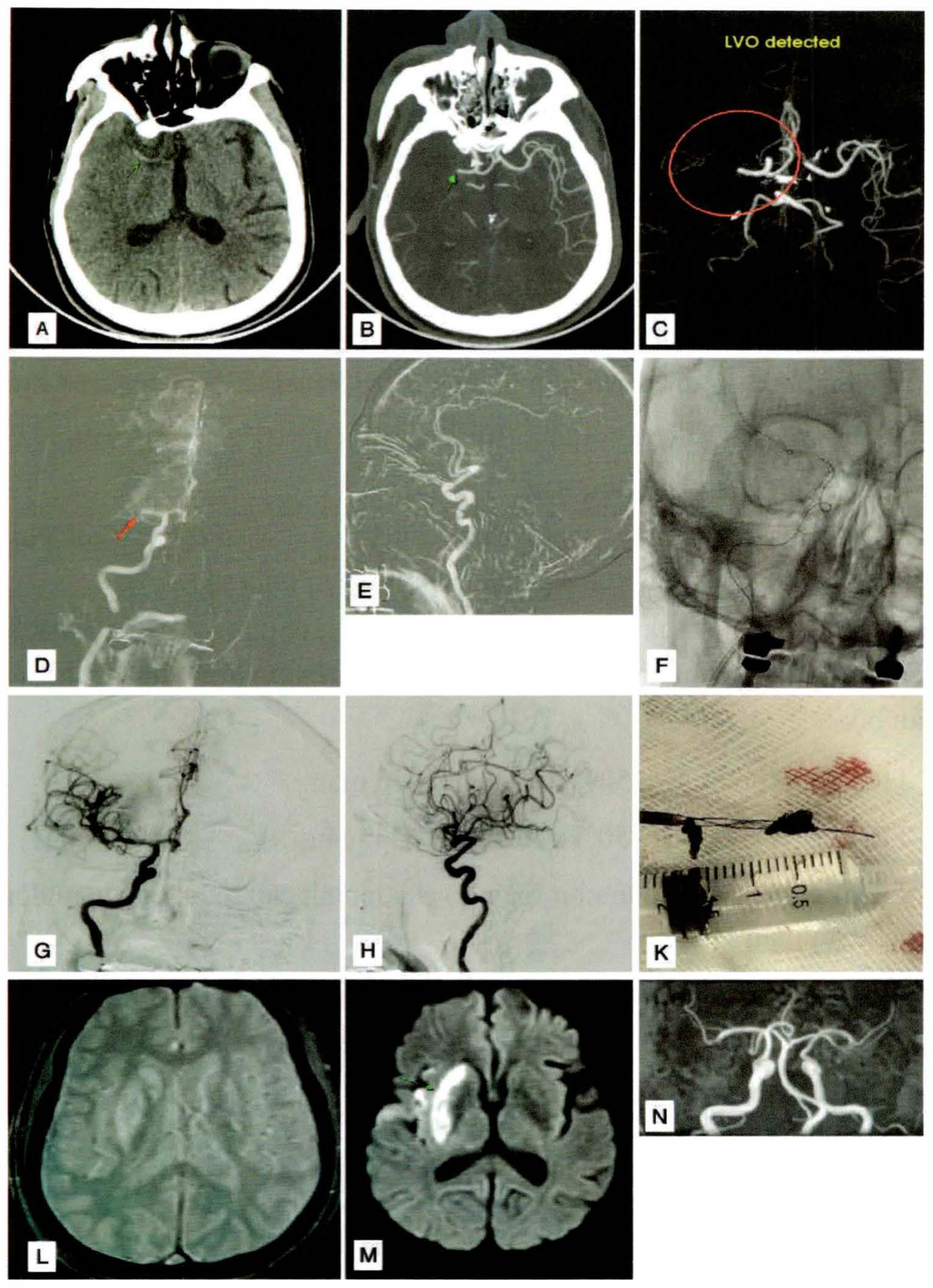 Ca lấy huyết khối với CT CTA DSA MRI và mẫu huyết khối