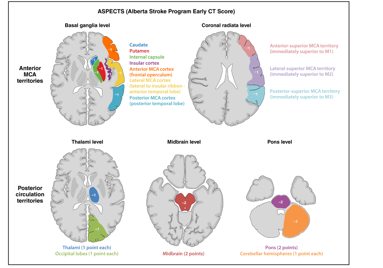 Sơ đồ ASPECTS và pc-ASPECTS