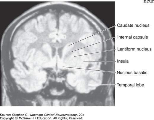 Hình MRI mặt phẳng trán cho thấy nhân đuôi, bao trong, nhân bèo và thùy đảo