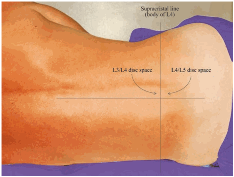 Vị trí chọc dò dịch não tủy thắt lưng ở khoang L3–L4 hoặc L4–L5