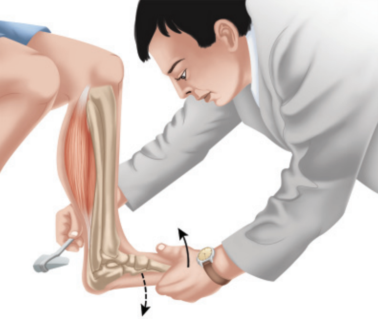 Khám phản xạ gân gót