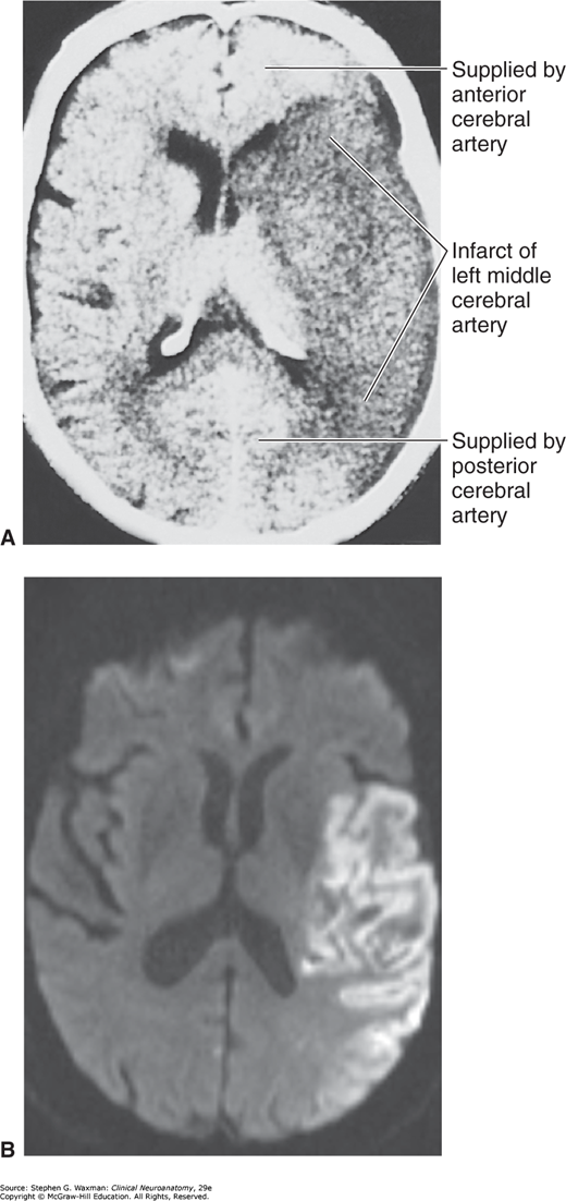 Nhồi máu động mạch não giữa trái trên CT và MRI khuếch tán
