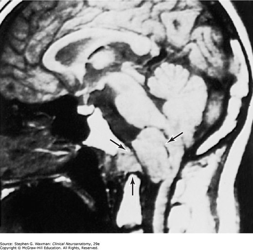 MRI sagittal T1 với mũi tên chỉ vùng cầu não, hành não và bể lớn bị chèn ép bởi khối choán chỗ hố sau