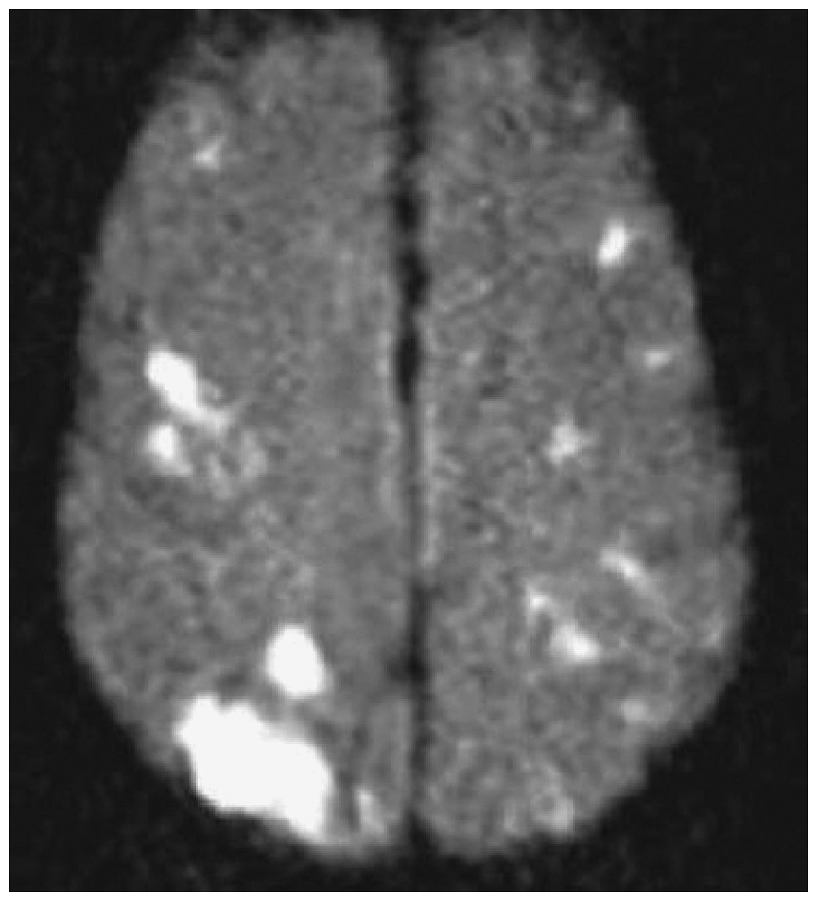 MRI khuếch tán cho thấy nhiều ổ thuyên tắc mạch não nhỏ rải rác gây mê sảng