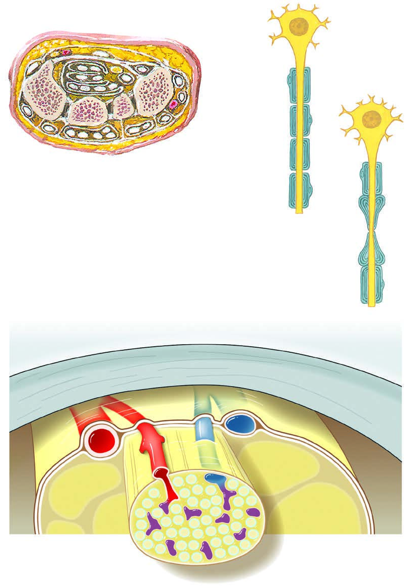 Mặt cắt dây thần kinh ngoại biên với sợi trục có myelin, eo Ranvier và tế bào Schwann