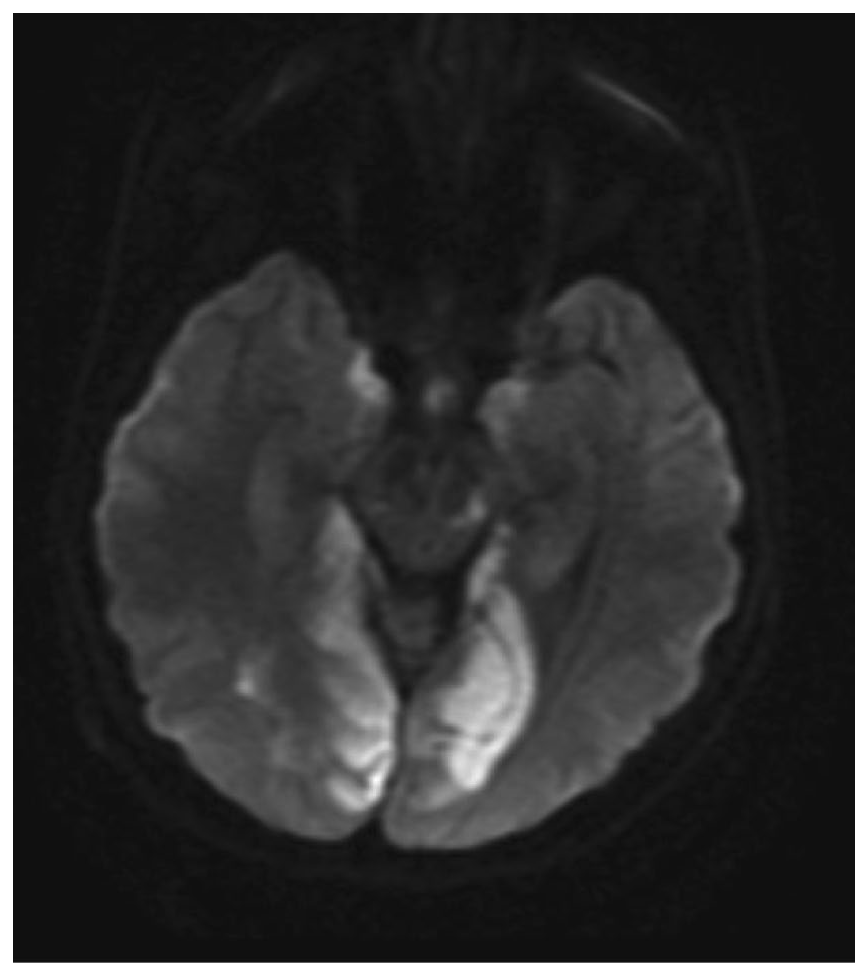 MRI khuếch tán: hạn chế khuếch tán thái dương trong và chẩm hai bên do nhồi máu vùng động mạch não sau