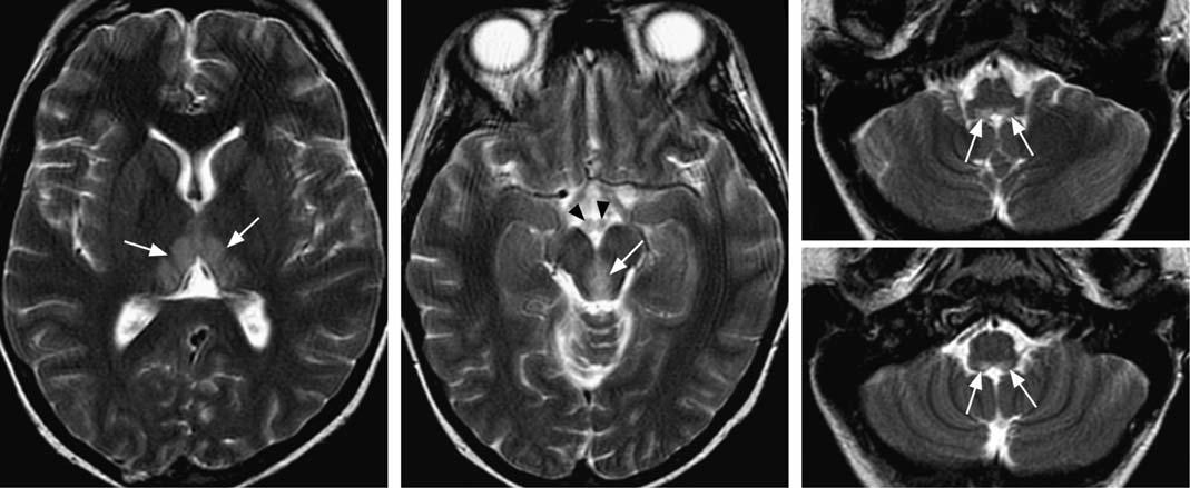 MRI T2 cắt ngang bệnh não Wernicke: tăng tín hiệu đối xứng đồi thị trong, quanh cống não, thể vú và nhân tiền đình trong