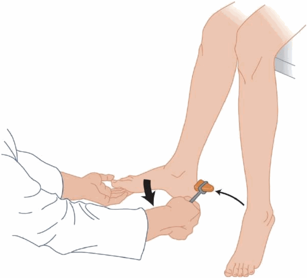 Khám phản xạ gót ở tư thế ngồi: một tay đẩy nhẹ gan bàn chân, tay kia gõ búa vào gân gót