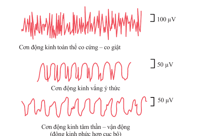 Sơ đồ điện não của cơn toàn thể co cứng–co giật, cơn vắng ý thức và cơn tâm thần–vận động