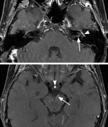 MRI sọ não cắt ngang sau tiêm thuốc đối quang, xóa mỡ, qua nền sọ: tăng bắt thuốc dọc các dây thần kinh sọ