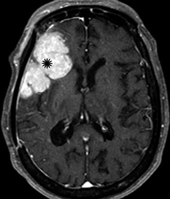 MRI T1 sau tiêm thuốc đối quang: khối ngoài trục bám màng cứng vùng trán phải, ngấm thuốc mạnh và đồng nhất