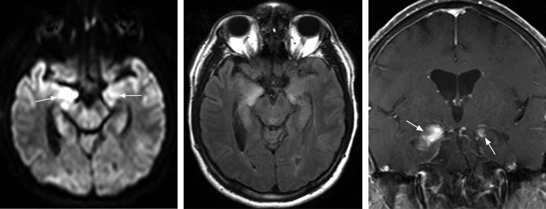 MRI viêm não Herpes: DWI và FLAIR cắt ngang tăng tín hiệu thùy thái dương trong hai bên, T1 cắt vành sau tiêm thuốc ngấm thuốc thái dương trong hai bên